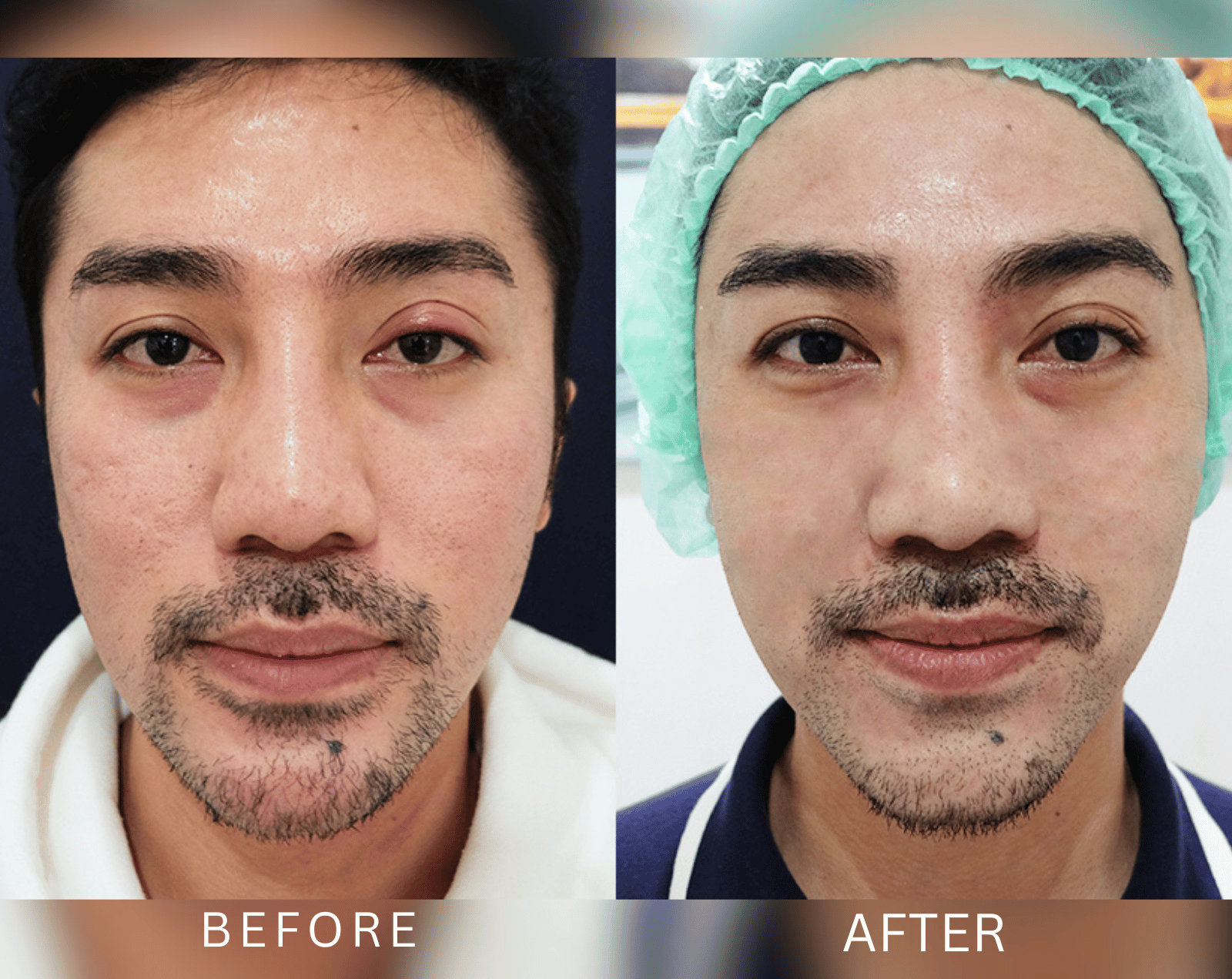 Before After Pico Laser Real 3