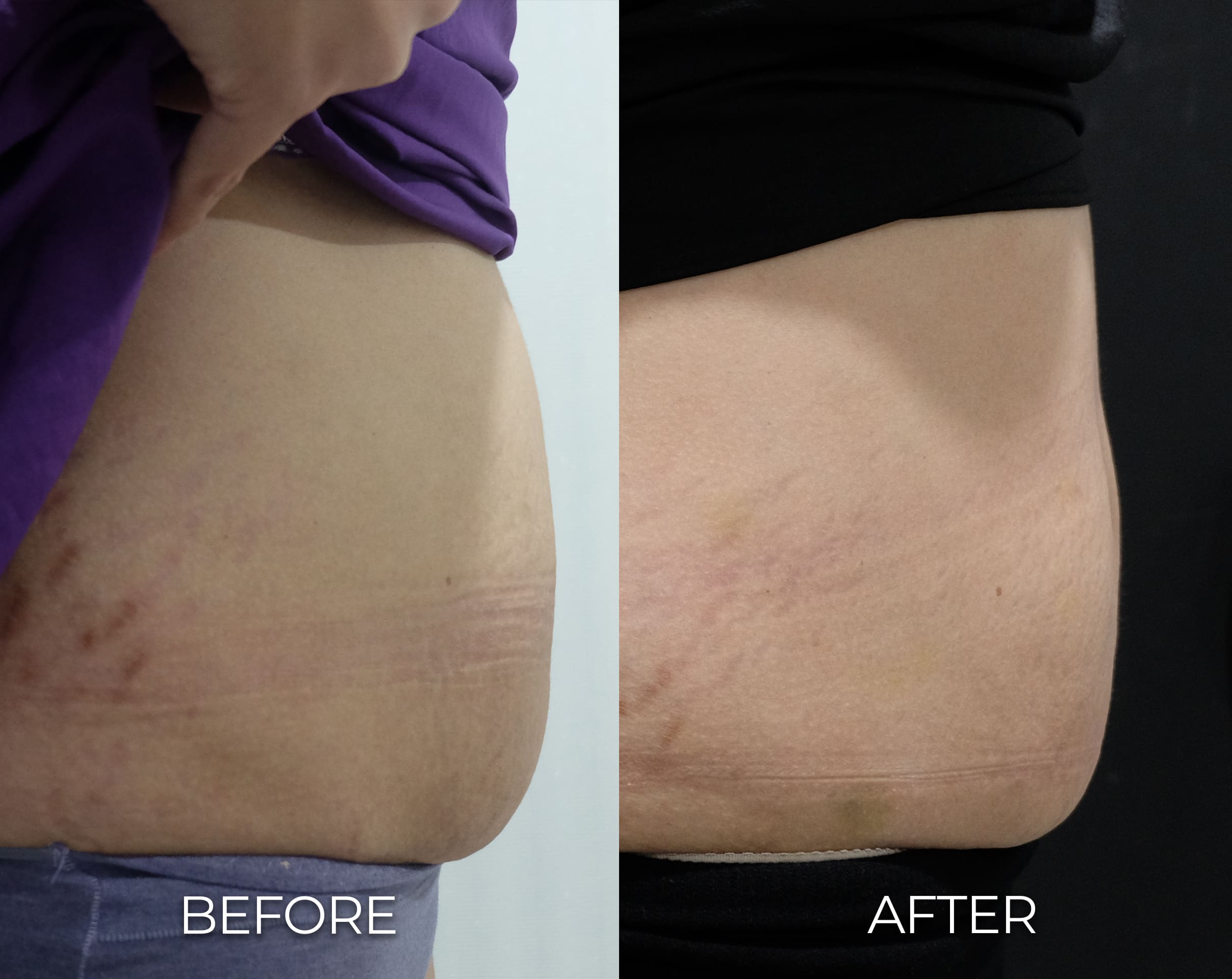 LIPO 1