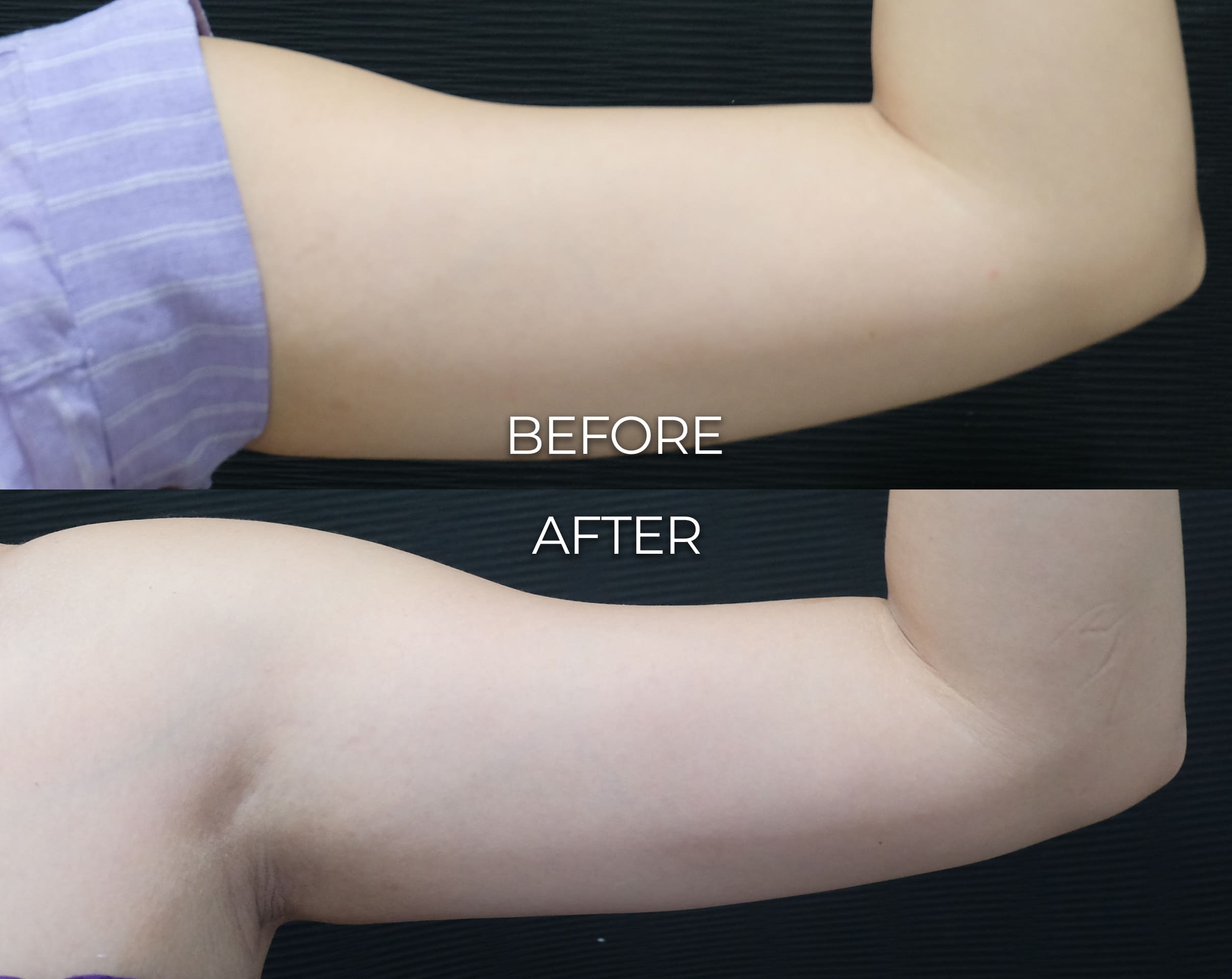 LIPO 2